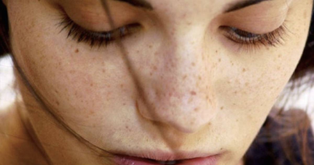 Por qué aparecen manchas en la cara y cómo eliminarlas