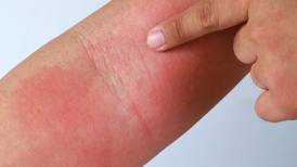 Estos 5 remedios naturales te ayudarán a aliviar la dermatitis