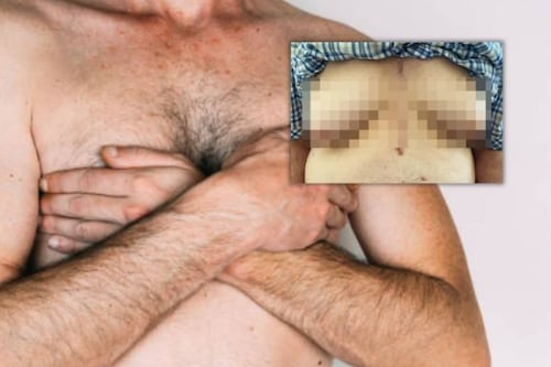 Medicamento para el corazón provocó crecimiento de senos en un hombre de 76 años