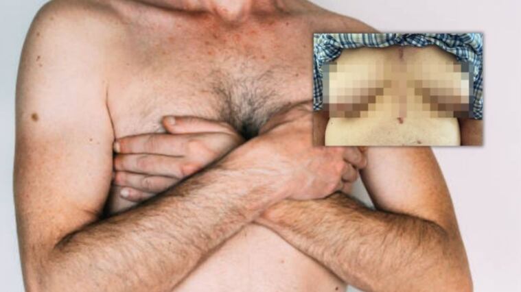 Medicamento para el corazón provocó crecimiento de senos en un hombre de 76 años