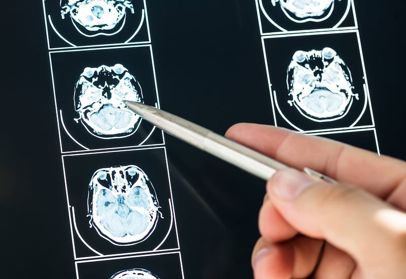 accidente cerebrovascular