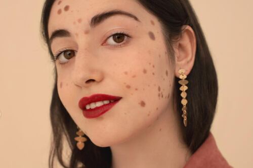 Alba Parejo: la modelo que enamora y concientiza con sus mil lunares