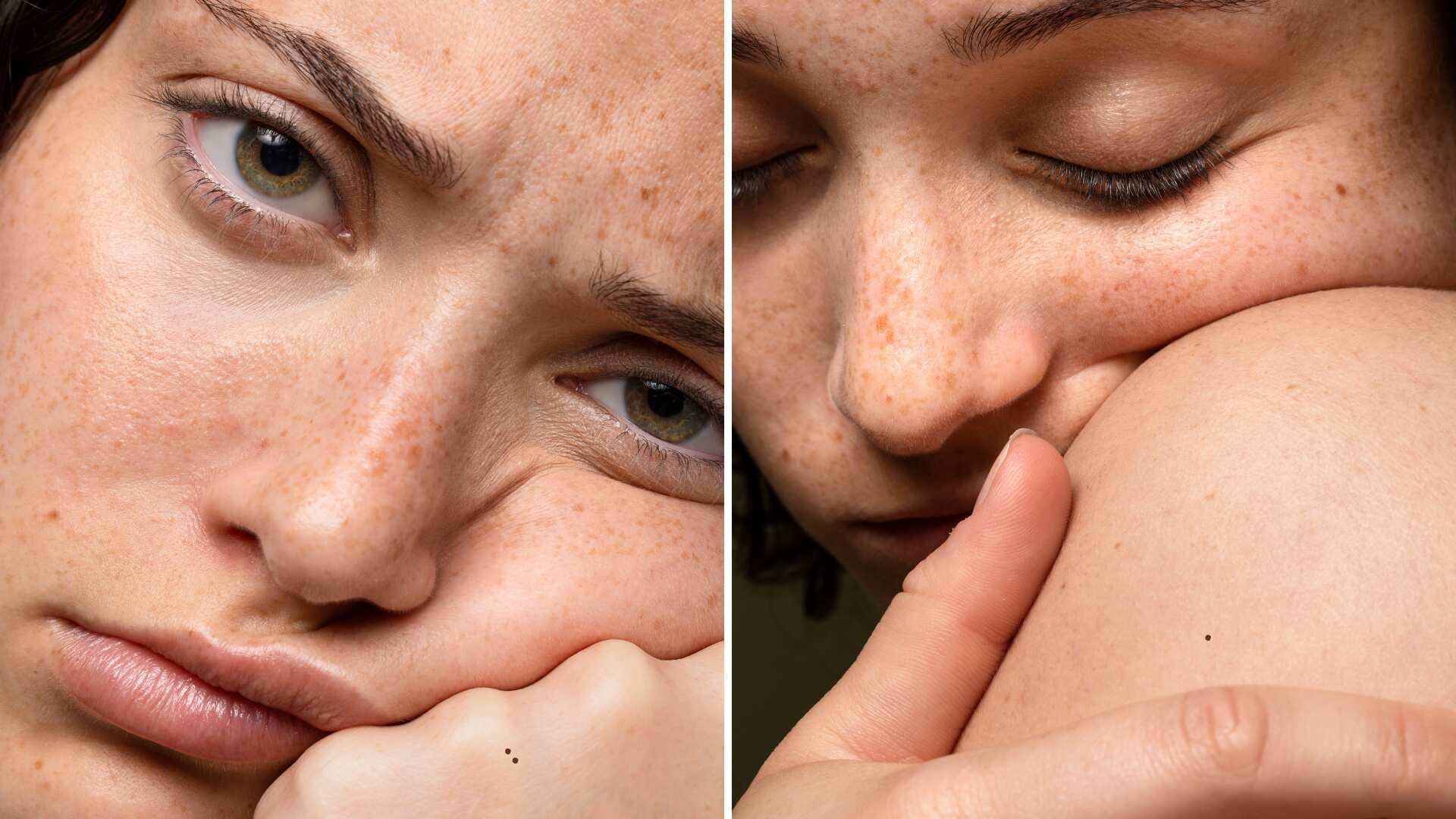 Manchas en la piel por el verano.