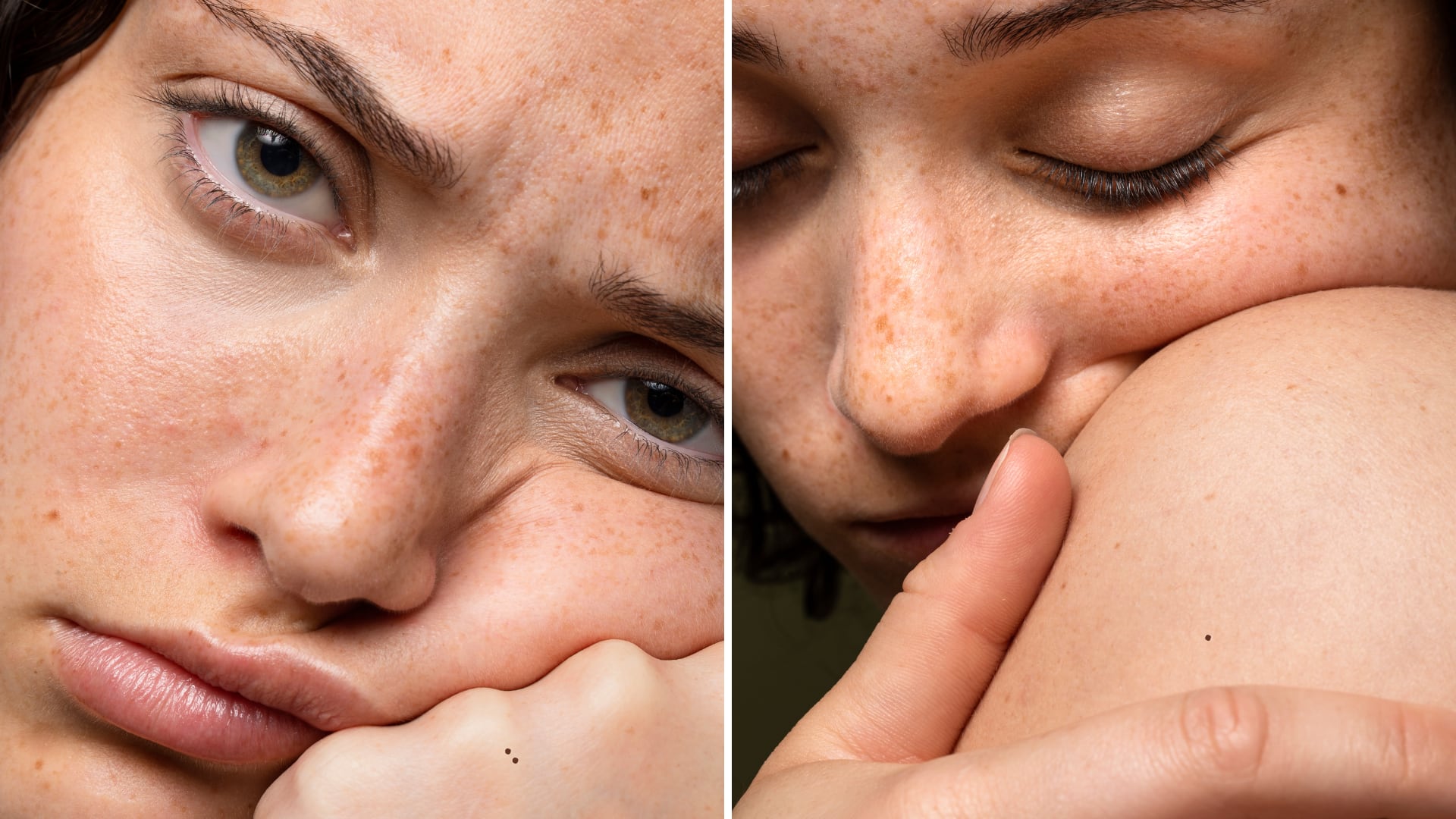 Manchas en la piel por el verano.