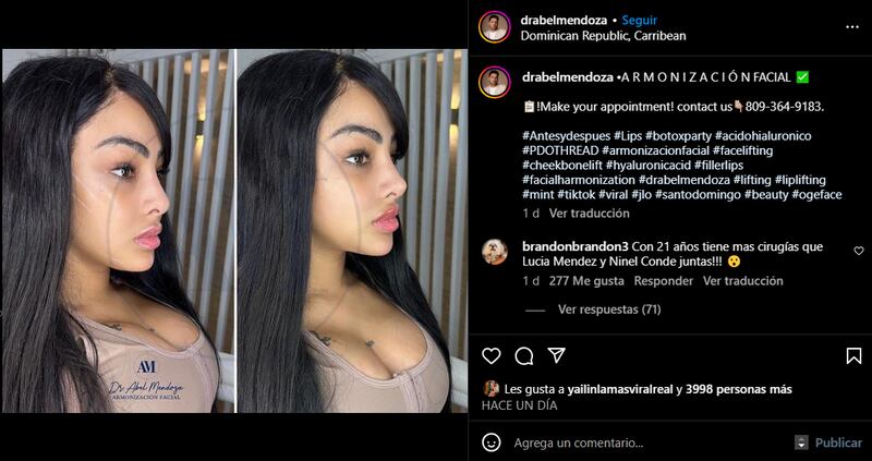 Yailin presumió una nueva nariz