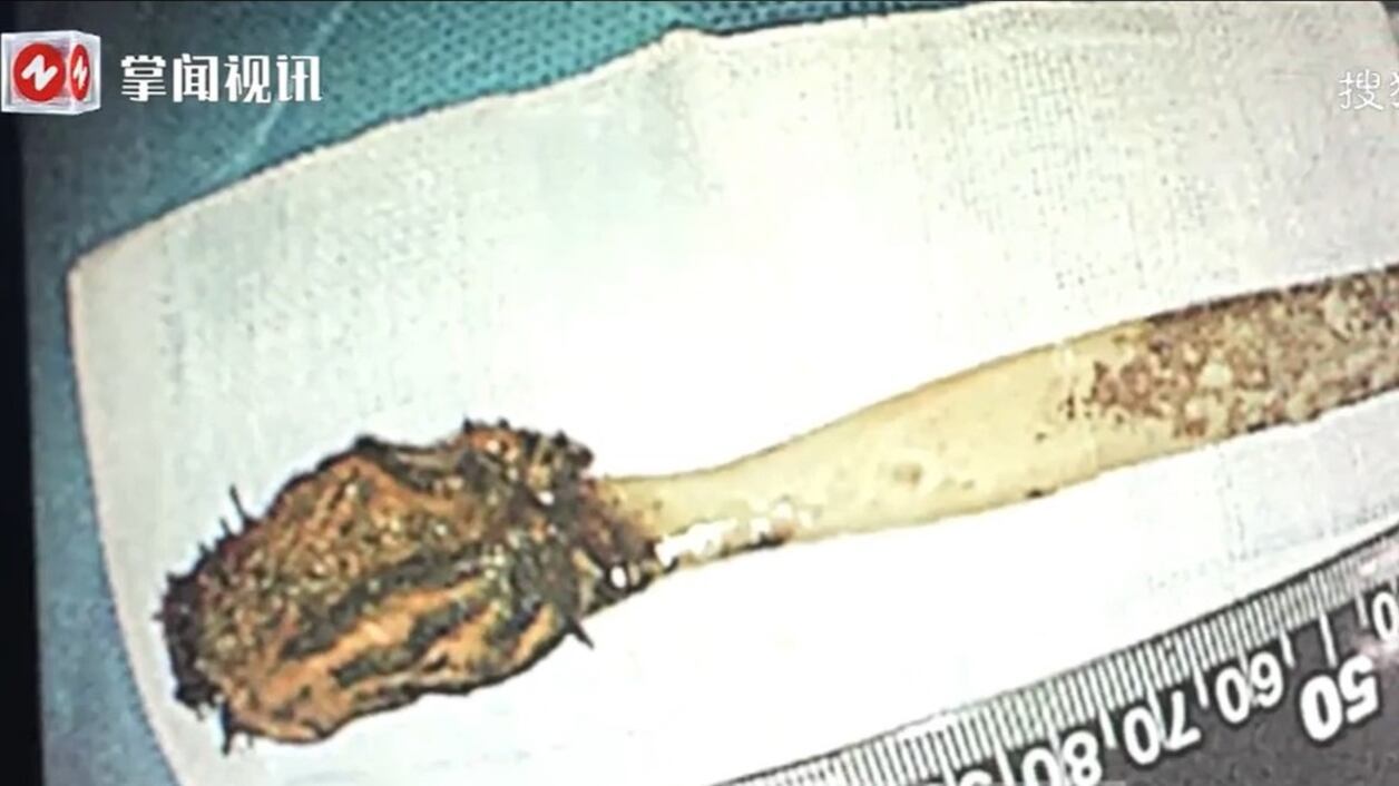 Fue al hospital por un dolor abdominal y tenía un cepillo de dientes atrapado desde hace 50 años