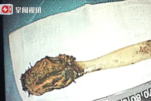 Fue al hospital por un dolor abdominal y tenía un cepillo de dientes atrapado desde hace 50 años