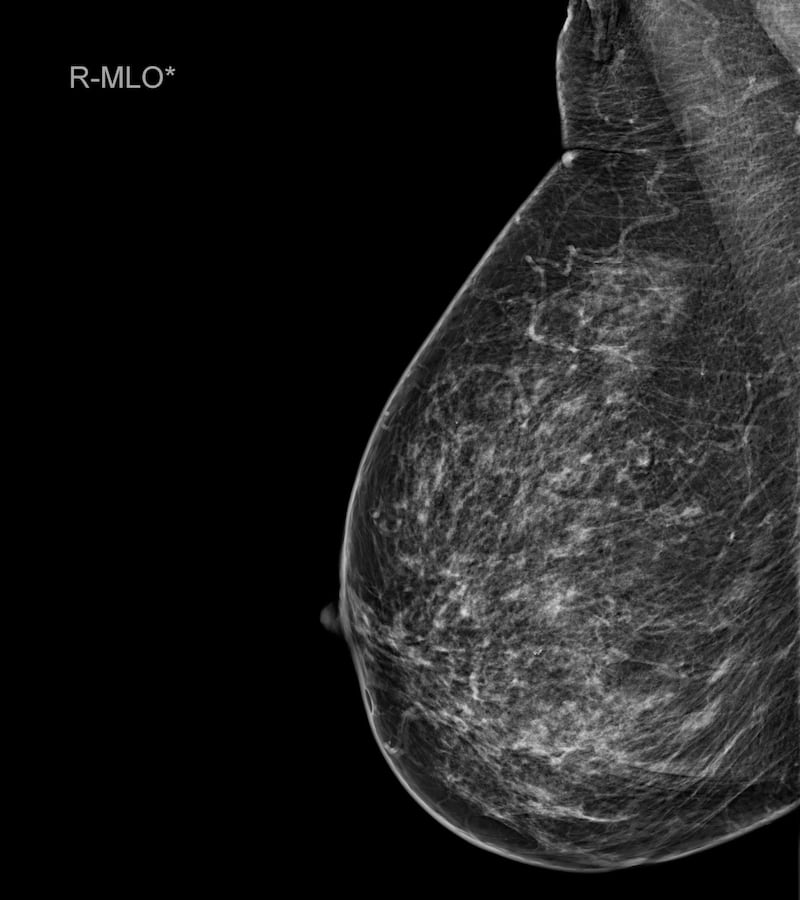 Cáncer de mama