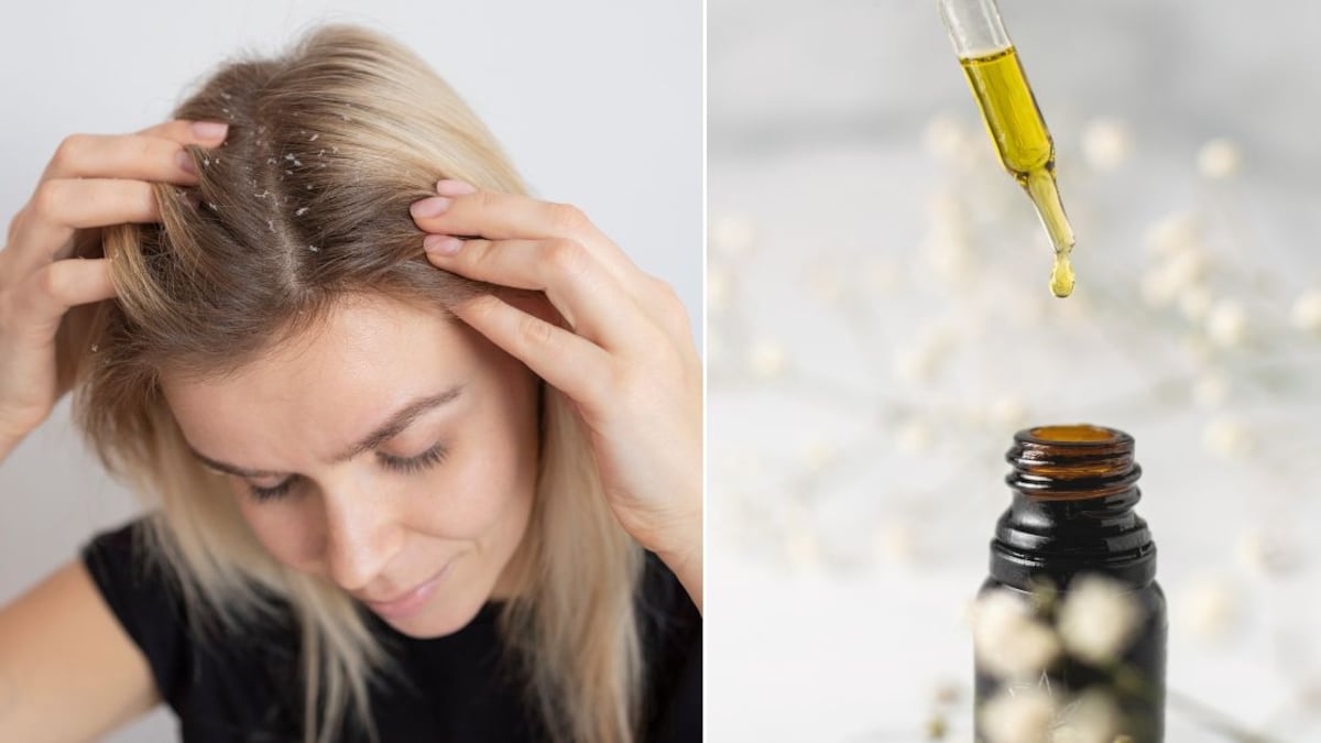 La caspa es una afección común que causa mucha vergüenza en quienes la padecen