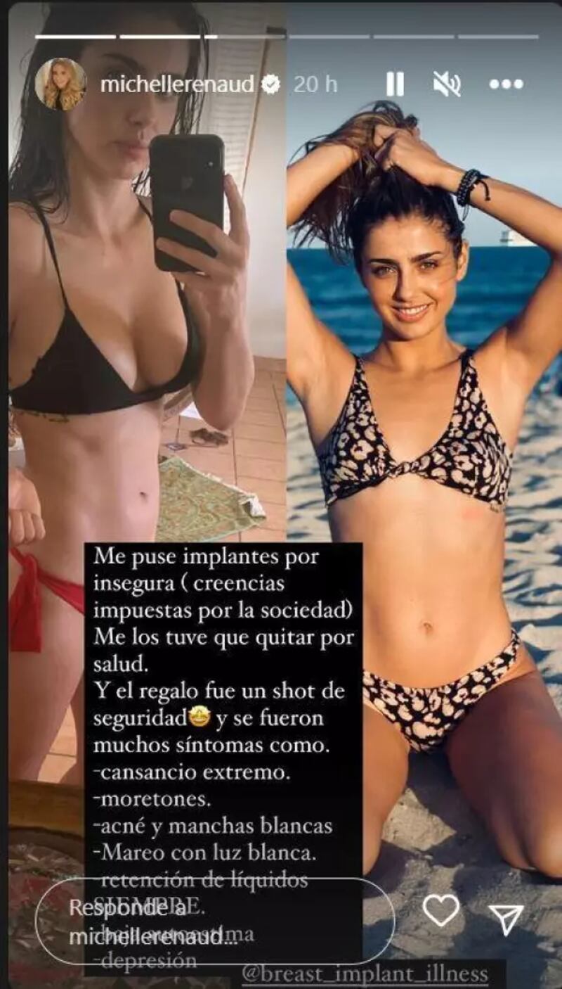 Michelle Renaud implantes mamarios