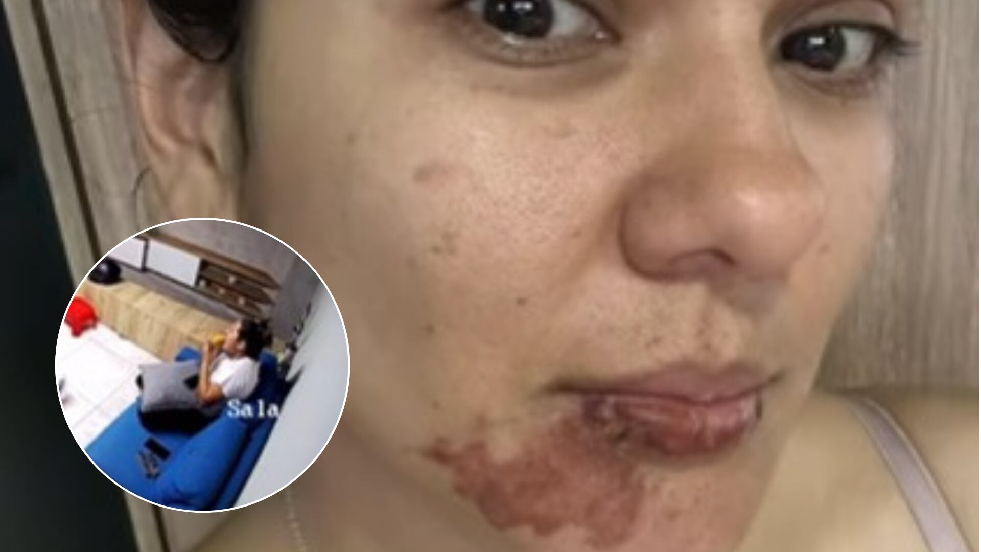 Mujer resultó quemada por empanada que le explotó al morderla