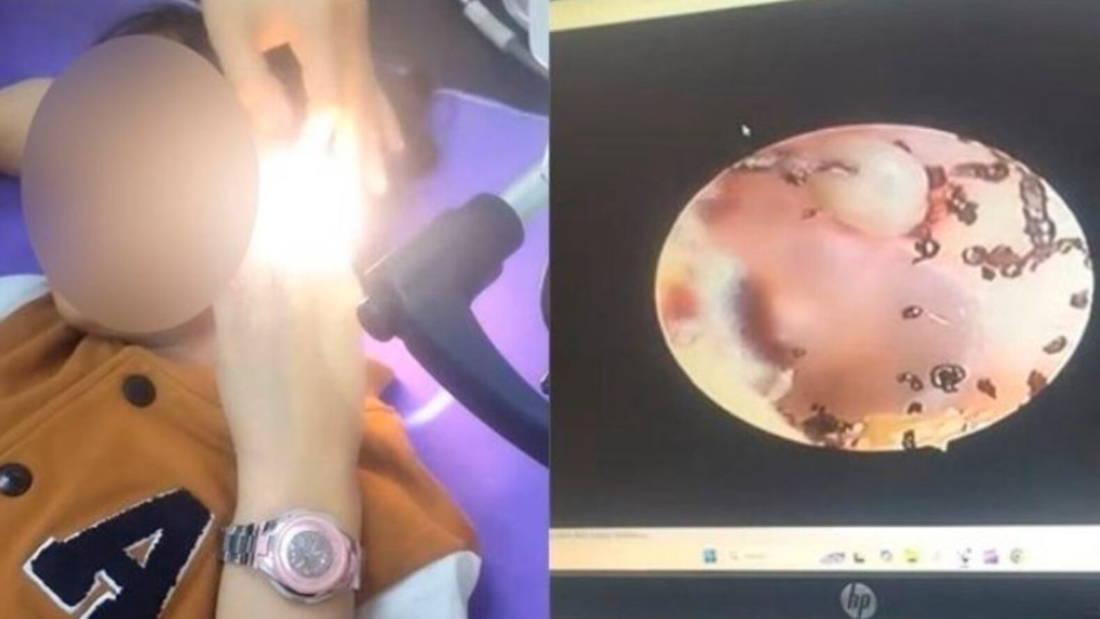 Una pequeña se quejaba de un dolor en el oído y los médicos le encontraron algo terrorífico