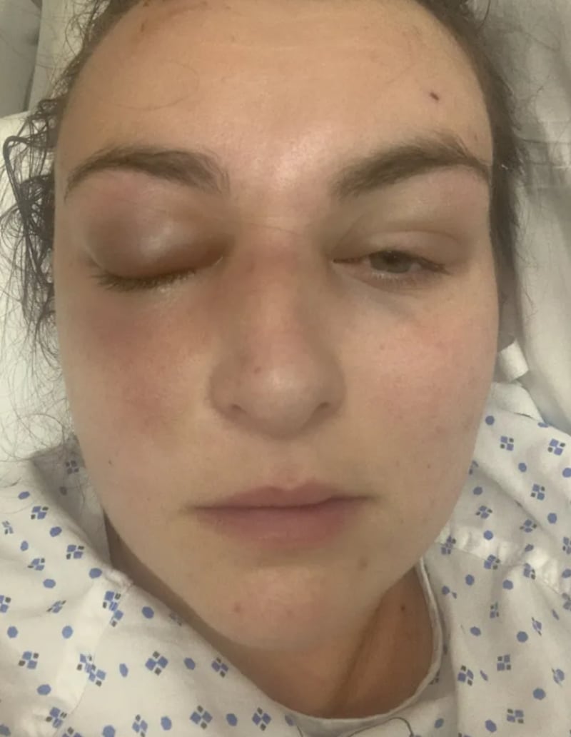 Mujer descubrió un tumor cerebral tras retirarse sus pestañas postizas de gran tamaño - Fuente: Foto de la web