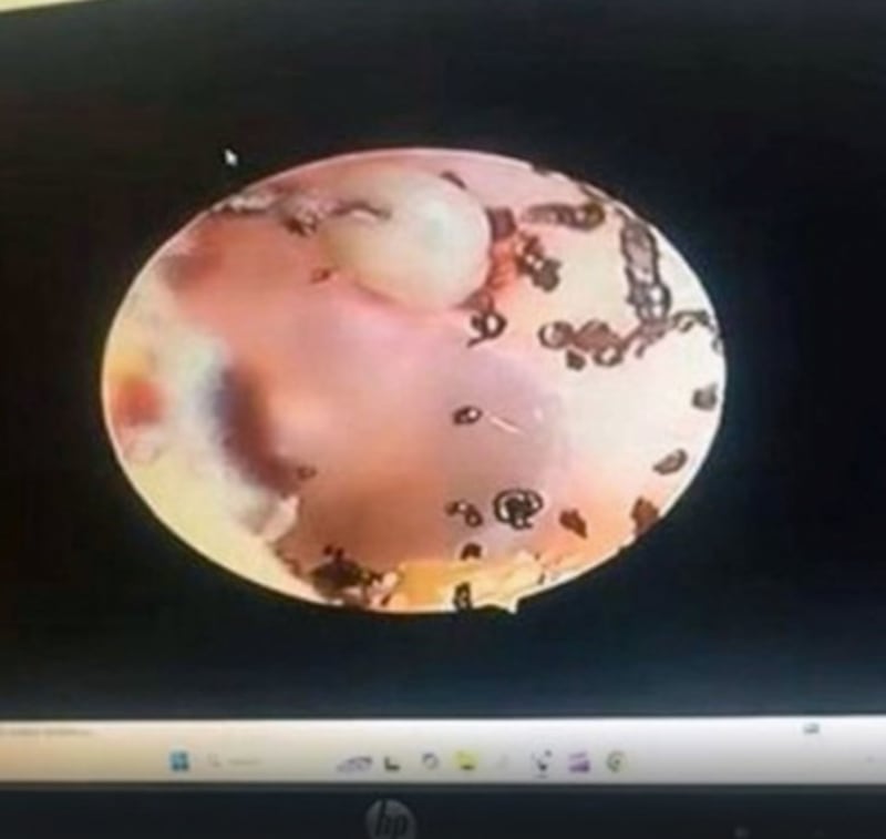 Una pequeña se quejaba de un dolor en el oído y los médicos le encontraron algo terrorífico