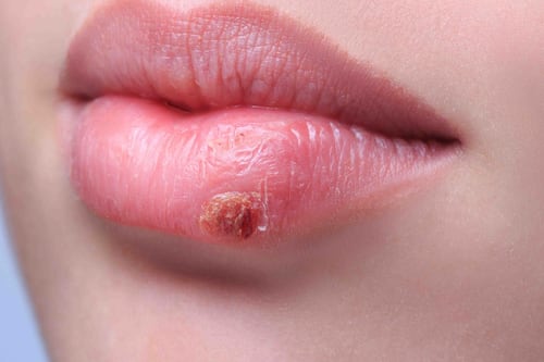 Estas son las causas más resaltantes por lo que se genera el herpes labial