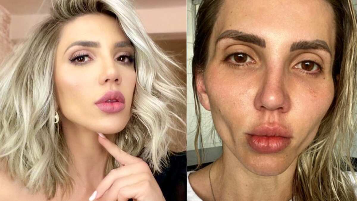 Influencer y bichectomía