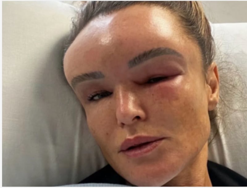 Mujer revela cómo comenzó enfermedad que deformó su rostro tras el estrés