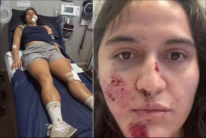 Mujer sufrió múltiples fracturas en la cara y el cuello tras ser atacada por un pájaro