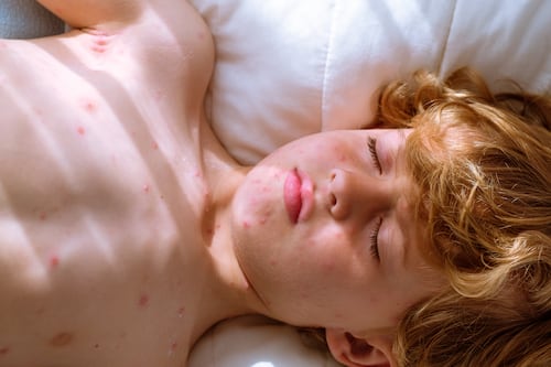 Más de 14.800 casos confirmados de sarampión en las Américas; Ecuador intensifica vacunación para evitar brotes