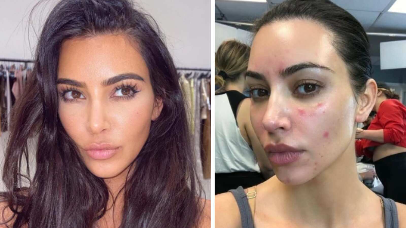 Kim Kardashian acné