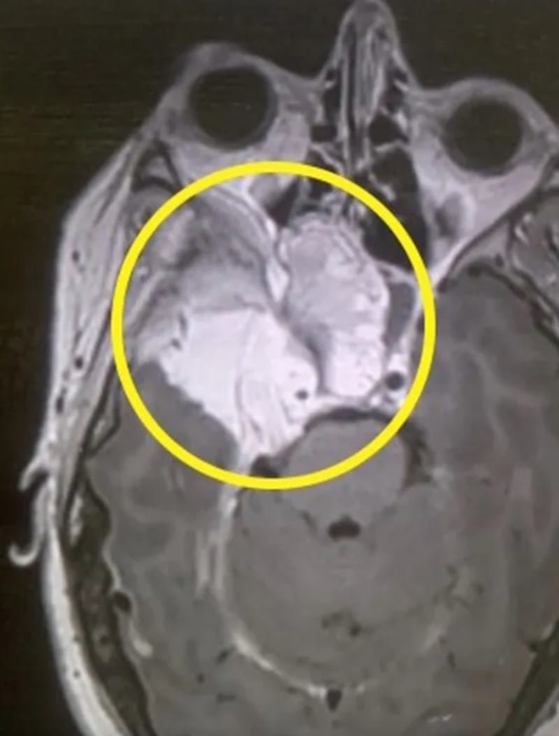 Mujer descubrió un tumor cerebral tras retirarse sus pestañas postizas de gran tamaño - Fuente: Foto de la web