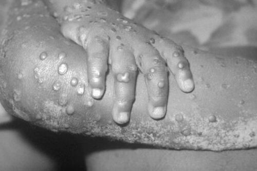 Es posible que la Viruela del Mono se propagó a través de un contacto sexual