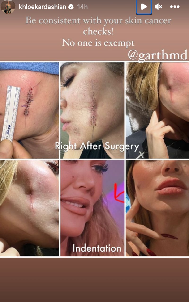Khloé Kardashian luchó contra un tumor facial
