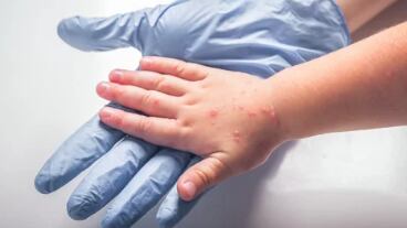 Síndrome manos – pies – boca