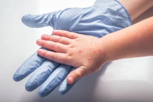 El síndrome manos-pies-boca: ¡Una enfermedad misteriosa que debes conocer y saber cómo identificar!