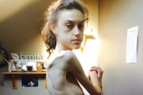 Chica se negaba a sentarse durante todo el día para perder peso