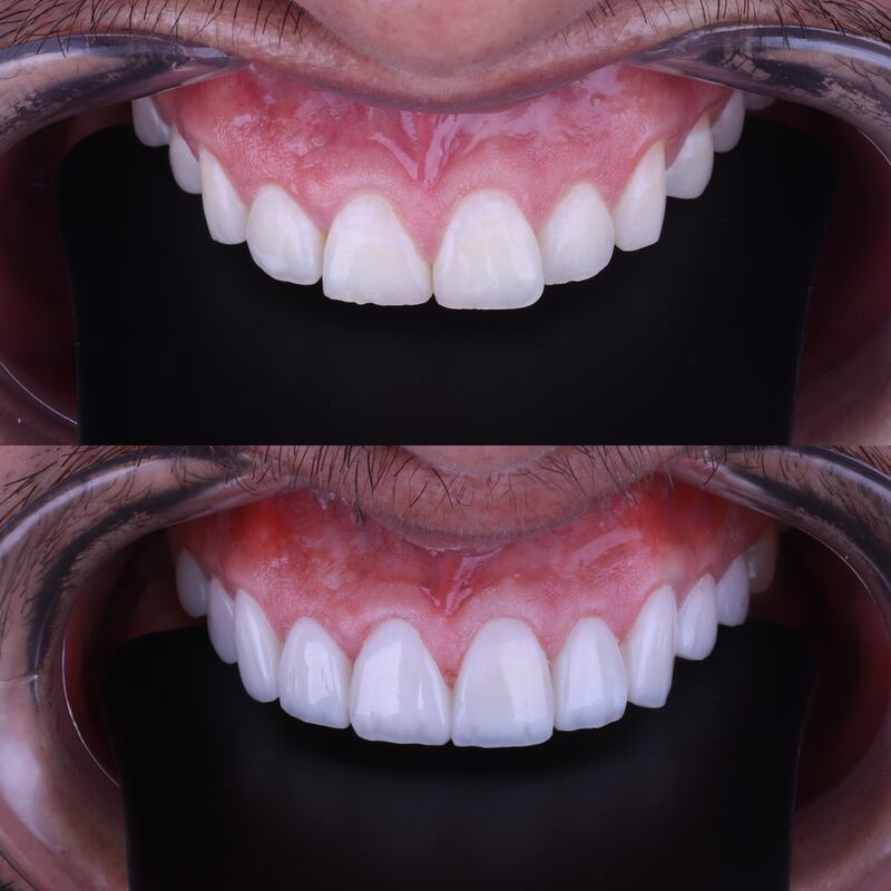Un buen diseño de sonrisa por el doctor Nelson Serrano