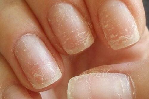 Conoce las enfermedades que reflejan la uñas