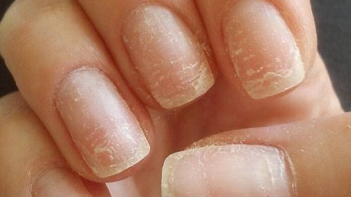 Algunos productos químicos de mala calidad afectan las uñas.